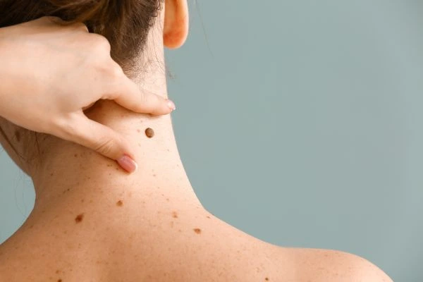 skin blemish removal Felixstowe treatment