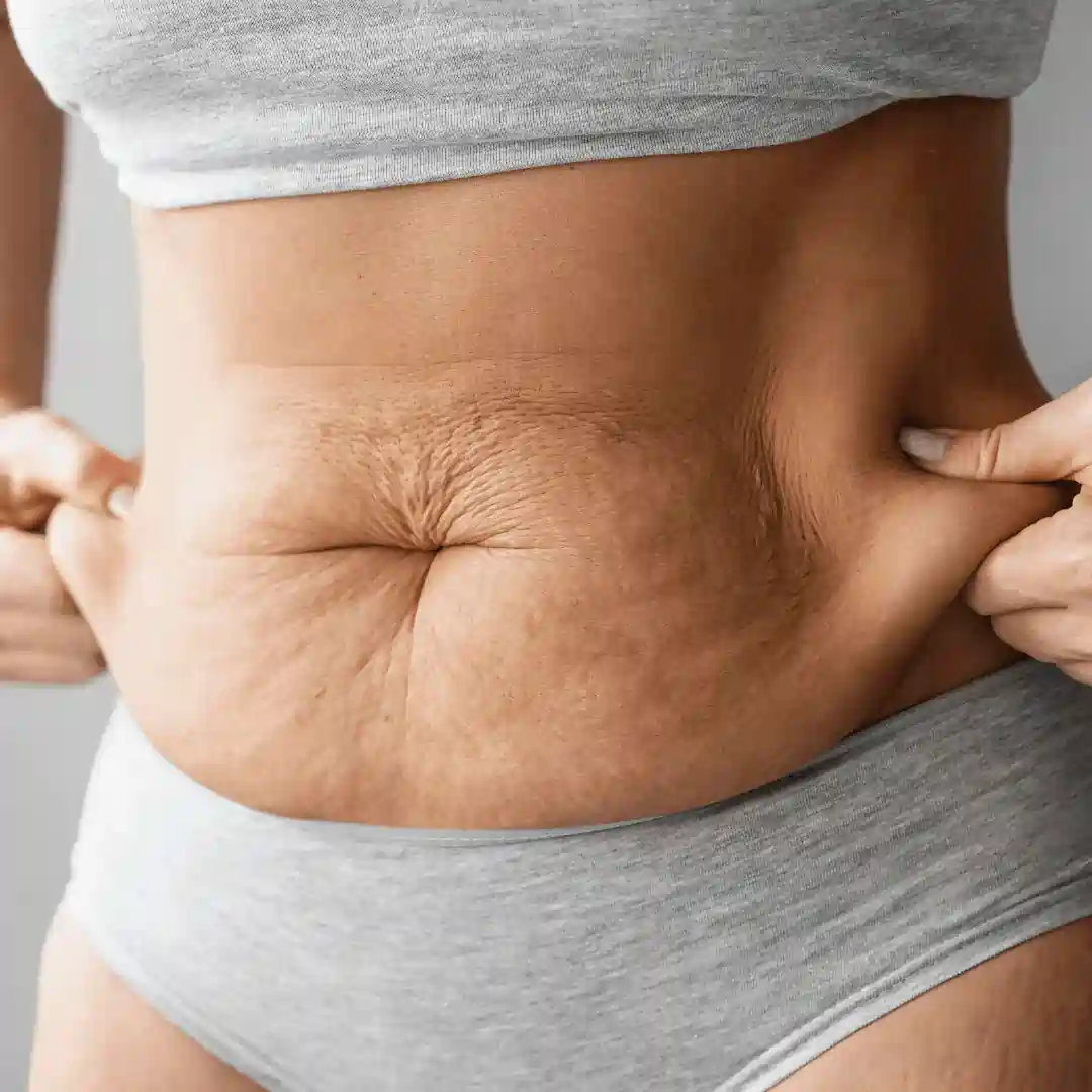 Is It Normal to Have Loose Skin After Pregnancy Felixstowe?